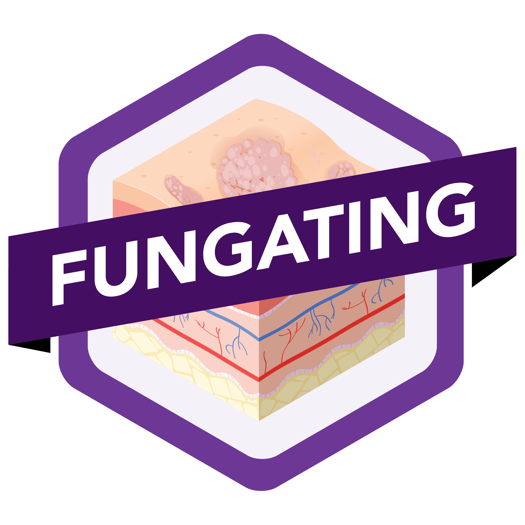 Fungating